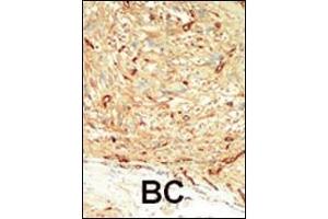 Formalin-fixed and paraffin-embedded human cancer tissue reacted with the primary antibody, which was peroxidase-conjugated to the secondary antibody, followed by DAB staining. (MST1 antibody  (C-Term))