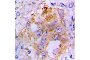 Immunohistochemical analysis of BMP3 staining in human lung cancer formalin fixed paraffin embedded tissue section.
