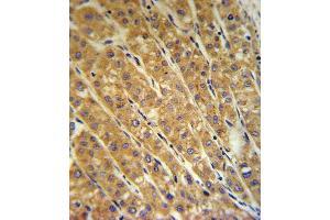 CP Antibody (Center) (ABIN391513 and ABIN2841474) IHC analysis in formalin fixed and paraffin embedded human hepatocarcinoma followed by peroxidase conjugation of the secondary antibody and DAB staining. (Ceruloplasmin antibody  (Center))