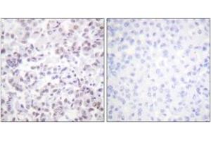 Immunohistochemistry analysis of paraffin-embedded human breast carcinoma tissue, using Histone H2B (Ab-12) Antibody. (Histone H2B antibody  (AA 10-59))