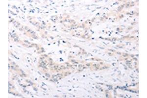 The image on the left is immunohistochemistry of paraffin-embedded Human colon cancer tissue using ABIN7131156(SPATA16 Antibody) at dilution 1/25, on the right is treated with fusion protein. (SPATA16 antibody)