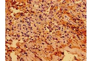 Immunohistochemistry of paraffin-embedded human cervical cancer using ABIN7172818 at dilution of 1:100 (TGFB1I1 antibody  (AA 138-200))