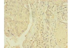 Immunohistochemistry of paraffin-embedded human lung cancer using ABIN7172152 at dilution of 1:100 (THRB antibody  (AA 1-461))