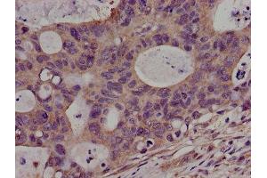 Immunohistochemistry of paraffin-embedded human colon cancer using ABIN7169080 at dilution of 1:100 (PKN2 antibody  (AA 925-969))