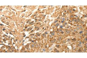 Immunohistochemistry of paraffin-embedded Human esophagus cancer using SLC25A11 Polyclonal Antibody at dilution of 1:30 (SLC25A11 antibody)
