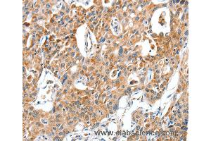 Immunohistochemistry of Human lung cancer using BAX Polyclonal Antibody at dilution of 1:30 (BAX antibody)