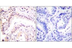 Immunohistochemistry analysis of paraffin-embedded human lung carcinoma tissue, using Cullin 2 Antibody. (Cullin 2 antibody  (AA 696-745))