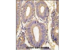 Formalin-fixed and raffin-embedded human colon carcinoma tissue reacted with K1 Antibody  (ABIN392432 and ABIN2842032) , which was peroxidase-conjugated to the secondary antibody, followed by DAB staining. (PAK1 antibody  (AA 401-430))