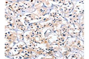 The image on the left is immunohistochemistry of paraffin-embedded Human thyroid cancer tissue using ABIN7128792(CATSPER1 Antibody) at dilution 1/40, on the right is treated with fusion protein. (CATSPER1 antibody)