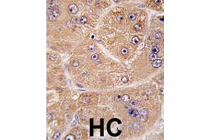 Formalin-fixed and paraffin-embedded human hepatocellular carcinoma reacted with FUCA2 polyclonal antibody  , which was peroxidase-conjugated to the secondary antibody, followed by DAB staining. (FUCA2 antibody  (N-Term))