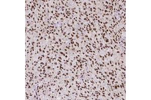 Immunohistochemical staining (Formalin-fixed paraffin-embedded sections) of human glioma with ATRX monoclonal antibody, clone CL0537  shows strong nuclear positivity in tumor cells.