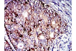 Immunohistochemical analysis of paraffin-embedded cervical cancer tissues using CD107b mouse mAb with DAB staining. (LAMP2 antibody  (AA 29-168))