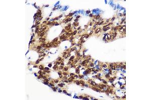 Immunohistochemistry of paraffin-embedded Human colon carcinoma using RBM15 Rabbit pAb (ABIN1682491, ABIN3019286, ABIN3019287, ABIN5664924 and ABIN6220805) at dilution of 1:100 (40x lens). (RBM15 antibody  (AA 530-780))