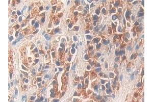 Detection of KLK11 in Human Prostate cancer Tissue using Polyclonal Antibody to Kallikrein 11 (KLK11) (Kallikrein 11 antibody  (AA 39-282))