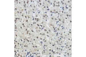 Immunohistochemistry of paraffin-embedded human liver cancer using BRAP Rabbit pAb (ABIN7265922) at dilution of 1:100 (40x lens). (BRAP antibody  (AA 1-200))