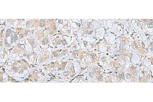 Immunohistochemistry of paraffin-embedded Human liver cancer tissue using BDNF Polyclonal Antibody at dilution of 1:65(x200) (BDNF antibody)