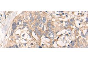Immunohistochemistry of paraffin-embedded Human lung cancer tissue using NREP Polyclonal Antibody at dilution of 1:35(x200) (NREP antibody)