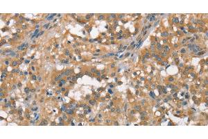 Immunohistochemistry of paraffin-embedded Human thyroid cancer using PLEKHO1 Polyclonal Antibody at dilution of 1:70 (PLEKHO1 antibody)