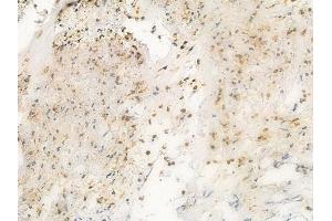 ABIN6260927 and ABIN6269194 at 1/100 staining human breast carcinoma by IHC-P.