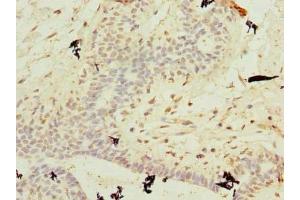Immunohistochemistry of paraffin-embedded human breast cancer using ABIN7174699 at dilution of 1:100 (AKNA Domain Containing 1 (AKNAD1) (AA 1-223) antibody)