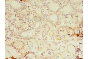 Immunohistochemistry of paraffin-embedded human breast cancer using ABIN7157249 at dilution of 1:100 (KBTBD4 antibody  (AA 151-415))