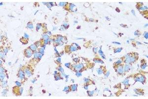 Immunohistochemistry of paraffin-embedded Human breast cancer using CA13 Polyclonal Antibody at dilution of 1:100 (40x lens). (CA13 antibody)