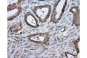 Immunohistochemical staining of paraffin-embedded Adenocarcinoma of colon tissue using anti-TPMT mouse monoclonal antibody. (TPMT antibody)
