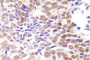 Immunohistochemistry (IHC)analyzes of HDAC1 antibody in paraffin-embedded human lung adenocarcinoma tissue. (HDAC1 antibody)