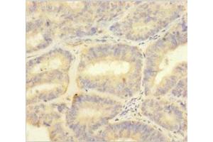Immunohistochemistry of paraffin-embedded human endometrial cancer using ABIN7166030 at dilution of 1:100 (S1A1 (AA 2-94) antibody)
