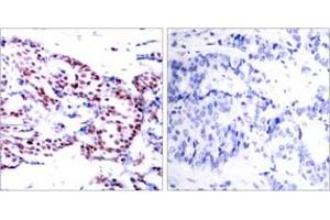 Immunohistochemistry analysis of paraffin-embedded human breast carcinoma tissue, using ATF2 (Ab-71 or 53) Antibody.