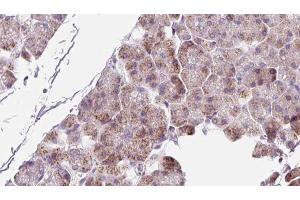 ABIN6273223 at 1/100 staining Human pancreas cancer tissue by IHC-P. (PPIC antibody  (Internal Region))