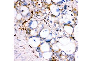 Anti- GPX1 antibody, IHC(P) IHC(P): Human Intestinal Cancer Tissue (Glutathione Peroxidase 1 antibody  (Middle Region))