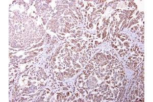 IHC-P Image Endomucin antibody [N1C2] detects Endomucin protein at cytosol on human lung carcinoma by immunohistochemical analysis. (Endomucin antibody)