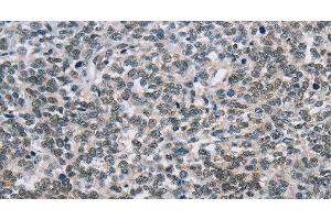 Immunohistochemistry of paraffin-embedded Human ovarian cancer tissue using TONSL Polyclonal Antibody at dilution 1:60 (NFKBIL2 antibody)