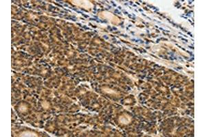 The image on the left is immunohistochemistry of paraffin-embedded Human thyroid cancer tissue using ABIN7130641(PIWIL4 Antibody) at dilution 1/25, on the right is treated with fusion protein. (PIWIL4 antibody)