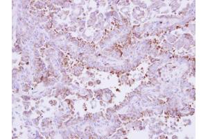 IHC-P Image Immunohistochemical analysis of paraffin-embedded human lung cancer, using Laminin beta 3, antibody at 1:250 dilution. (Laminin beta 3 antibody)