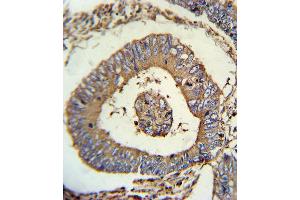 CALR Antibody immunohistochemistry analysis in formalin fixed and paraffin embedded human colon carcinoma followed by peroxidase conjugation of the secondary antibody and DAB staining. (GOPC antibody)