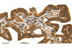 Immunohistochemistry of paraffin-embedded Human thyroid cancer using STX11 Polyclonal Antibody at dilution of 1:30 (Syntaxin 11 antibody)