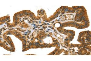 Immunohistochemistry of paraffin-embedded Human thyroid cancer using STX11 Polyclonal Antibody at dilution of 1:30