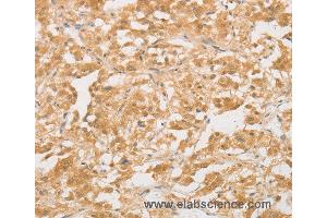 Immunohistochemistry of Human colon cancer using CD24 Polyclonal Antibody at dilution of 1:40 (CD24 antibody)