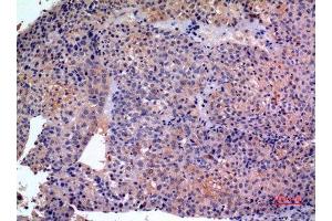 Immunohistochemistry (IHC) analysis of paraffin-embedded Human Liver Cancer, antibody was diluted at 1:100. (SCCA1/2 (Internal Region) antibody)