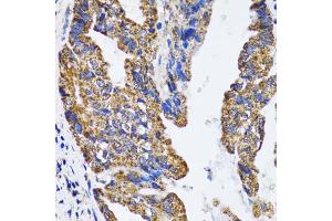 Immunohistochemistry of paraffin-embedded human gastric cancer using TP53 antibody (ABIN5973383) at dilution of 1/100 (40x lens). (p53 antibody)