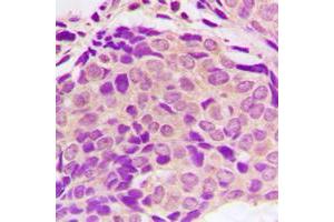 Immunohistochemical analysis of SH2D4A staining in human breast cancer formalin fixed paraffin embedded tissue section. (SH2D4A antibody  (Center))