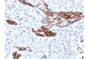 Formalin-fixed, paraffin-embedded human Gastric Carcinoma stained with MUC6 Rabbit Recombinant Monoclonal Antibody (MUC6/1553R). (Recombinant MUC6 antibody)