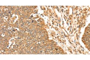 Immunohistochemistry of paraffin-embedded Human lung cancer using ERK 5 Polyclonal Antibody at dilution of 1:35 (MAPK7 antibody)