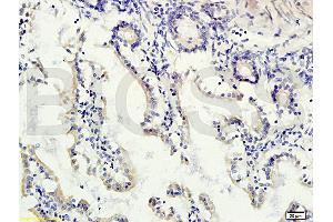 Formalin-fixed and paraffin embedded human colon carcinoma labeled with Rabbit Anti-gremlin Polyclonal Antibody (ABIN687082) at 1:200 followed by conjugation to the secondary antibody and DAB staining. (GREM1 antibody  (AA 101-184))