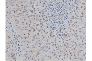 ABIN6267230 at 1/200 staining Human lung cancer tissue sections by IHC-P. (IKK-alpha /IKK-beta antibody  (pSer180, pSer181))