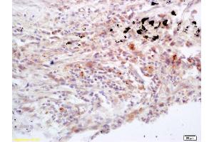 Formalin-fixed and paraffin embedded human lung carcinoma labeled with Rabbit Anti Jak3 Polyclonal Antibody, Unconjugated (ABIN681013) at 1:200 followed by conjugation to the secondary antibody and DAB staining