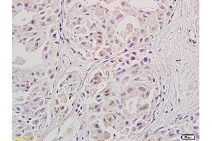 Formalin-fixed and paraffin embedded human ovary carcinoma labeled with Anti-Stra8, unconjugated (ABIN736133) at 1:800, followed by incubation with conjugated secondary antibody and DAB staining. (STRA8 antibody  (AA 201-300))