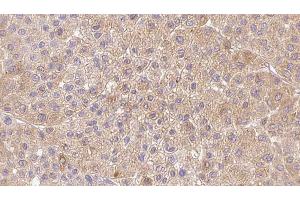 ABIN6273362 at 1/100 staining Human Melanoma tissue by IHC-P.